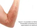 Brazo con erupción cutánea roja y elevada. La vitamina D es clave para la salud de la piel, especialmente para quienes sufren de dermatosis fotosensibles.