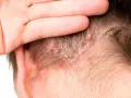 Una mano cubre parte de la cabeza, revelando parches rojos y escamosos en el cuero cabelludo, indicativos de dermatitis seborreica.