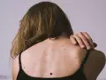 Vista posterior de una persona con granos en la espalda, algunos lunares y cabello castaño.