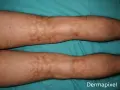 Piernas con manchas marrones irregulares y vello oscuro.