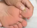 Dedo del pie con ampollas, mostrando varios tipos de ampollas en los pies.