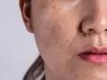 Primer plano de una cara con melasma y un pequeño lunar que parece un bigote.