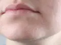 Primer plano de labios agrietados y piel seca cara con escamas visibles.