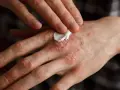 Persona aplica crema en sus manos afectadas por psoriasis, buscando alivio para la piel irritada.
