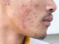 Primer plano de un rostro con acné severo. Se observa una oreja con un pendiente. El ácido hialurónico es bueno para el acné, ayudando a hidratar y calmar la piel.