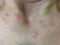 Primer plano de la piel del cuello y el pecho con varias ronchas rojas, algunas agrupadas y otras dispersas.