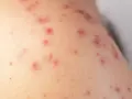 Primer plano de sarpullidos en la piel, con pequeñas protuberancias rojas y algunas marcas de acné.