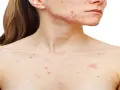 Persona con granos en el pecho y rostro, mostrando la afectación de la piel por acné.