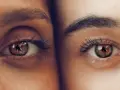 Primer plano de dos ojos, uno con ojeras vasculares pronunciadas, el otro con piel clara y sin ellas.