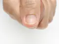 Uña con estrias verticales, mostrando la textura y posibles irregularidades.