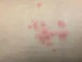 Manchas rosadas en la piel sin picor, agrupadas en racimos.