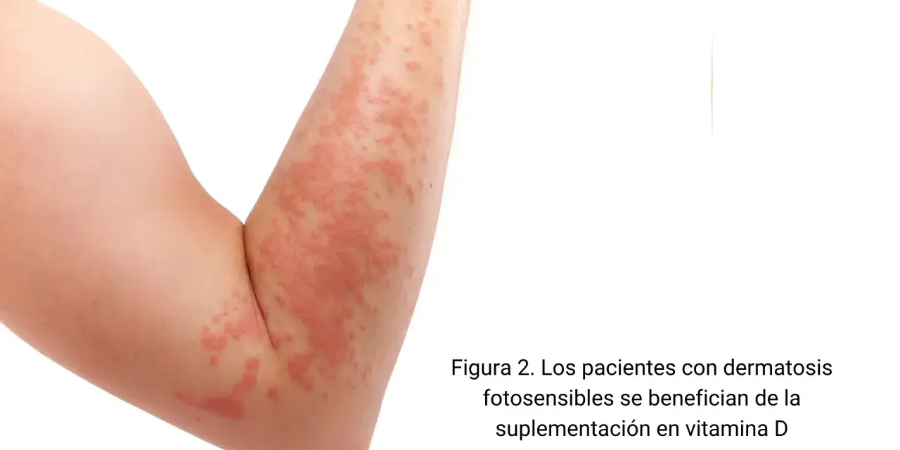 Brazo con erupción cutánea roja y elevada. La vitamina D es clave para la salud de la piel, especialmente para quienes sufren de dermatosis fotosensibles.