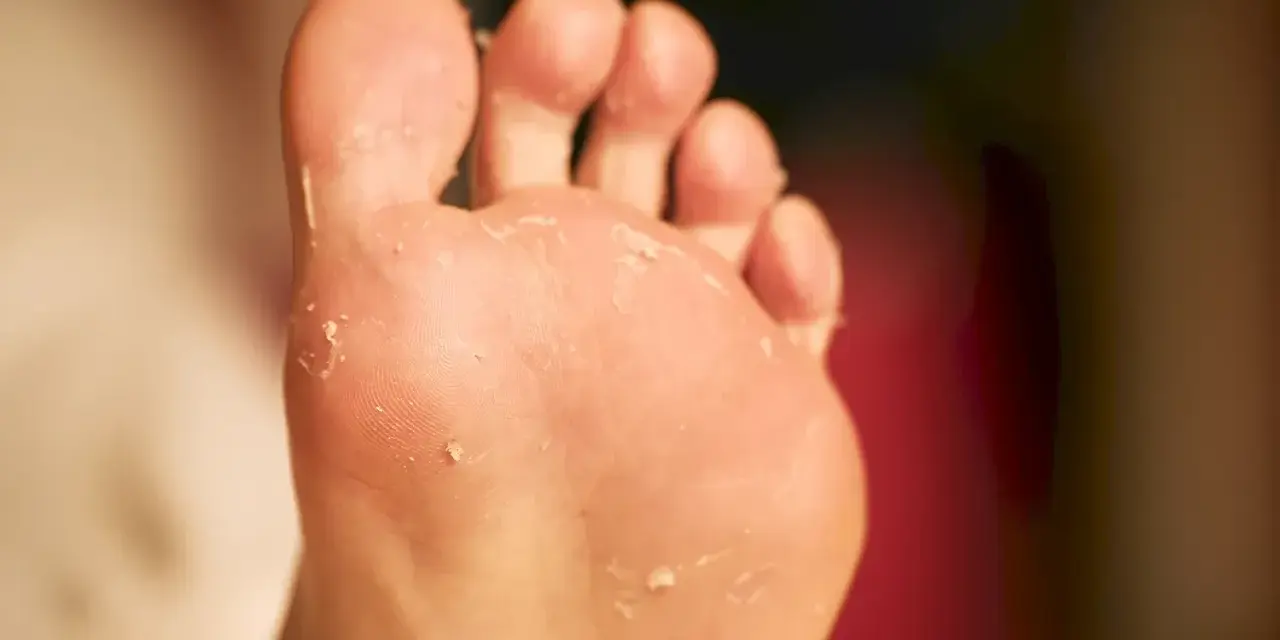 Piel descamada en el pie, indicando posibles tipos de hongos en los pies y cómo curarlos.