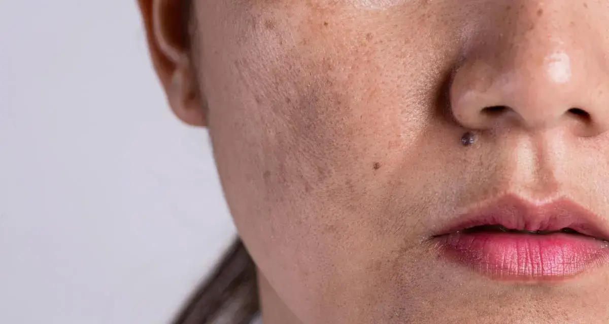 Primer plano de una cara con melasma y un pequeño lunar que parece un bigote.