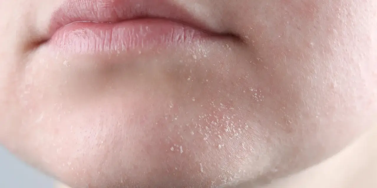 Primer plano de labios agrietados y piel seca cara con escamas visibles.