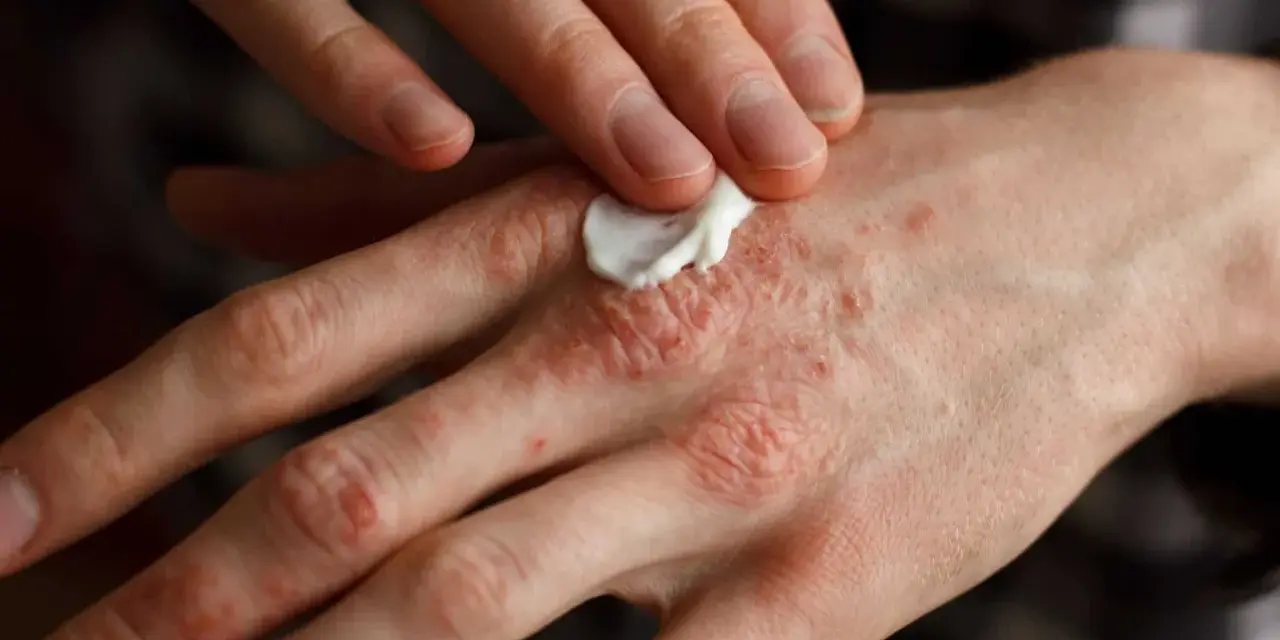 Persona aplica crema en sus manos afectadas por psoriasis, buscando alivio para la piel irritada.