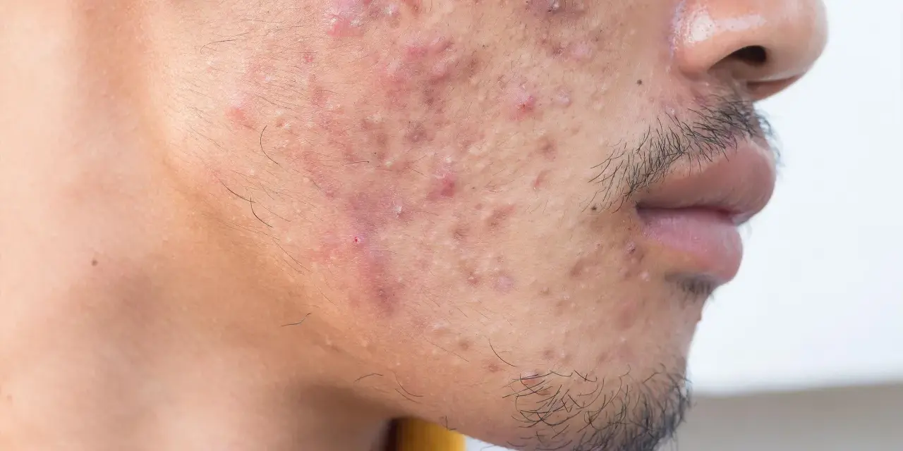 Primer plano de un rostro con acné severo. Se observa una oreja con un pendiente. El ácido hialurónico es bueno para el acné, ayudando a hidratar y calmar la piel.