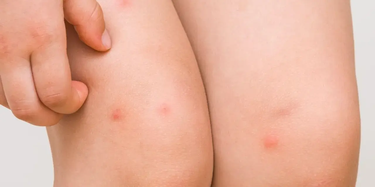 Un niño se rasca un sarpullido en las piernas. Se ven varias picaduras rojas y elevadas en la piel.