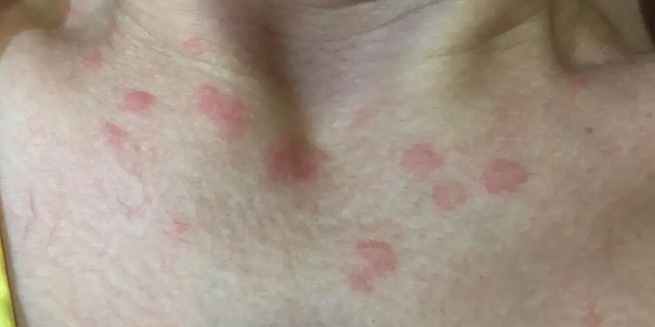 Primer plano de la piel del cuello y el pecho con varias ronchas rojas, algunas agrupadas y otras dispersas.