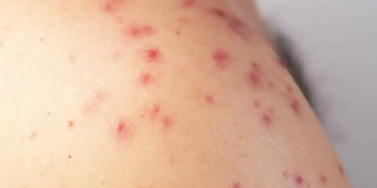 Primer plano de sarpullidos en la piel, con pequeñas protuberancias rojas y algunas marcas de acné.