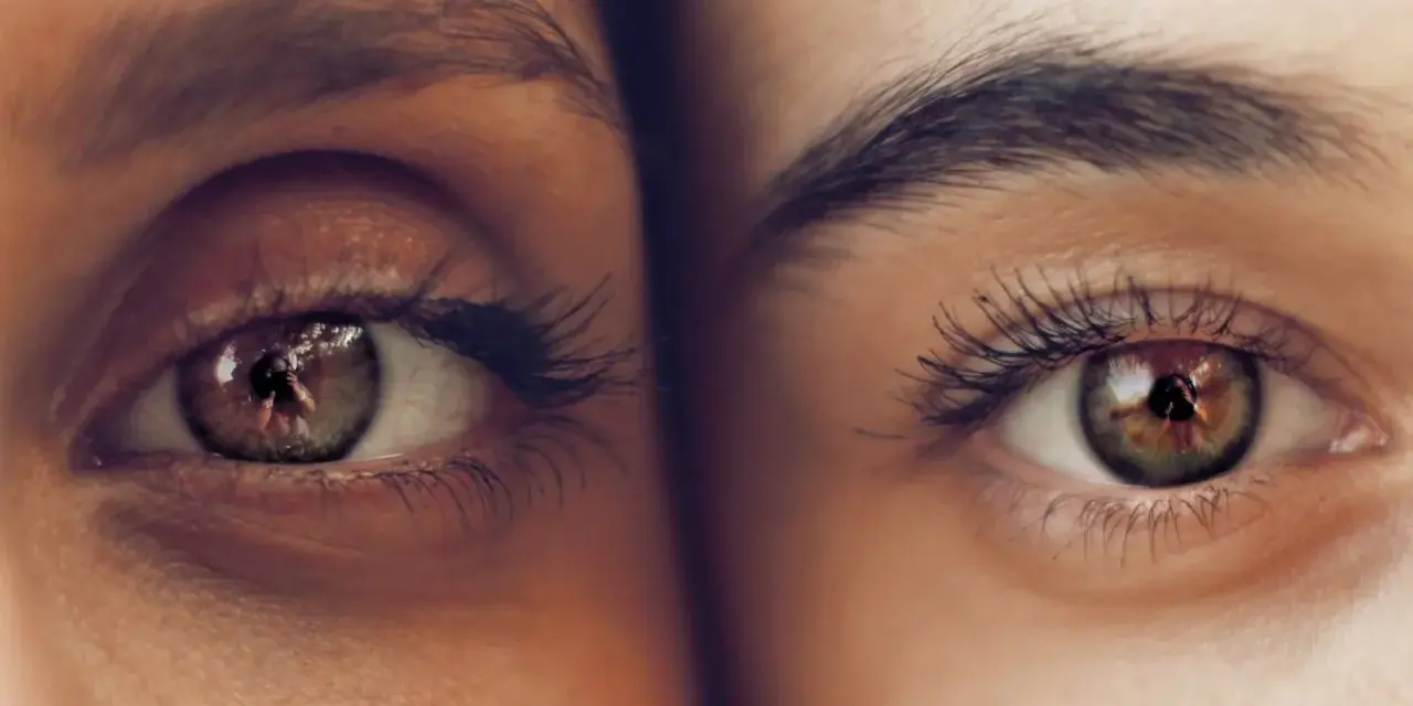 Primer plano de dos ojos, uno con ojeras vasculares pronunciadas, el otro con piel clara y sin ellas.