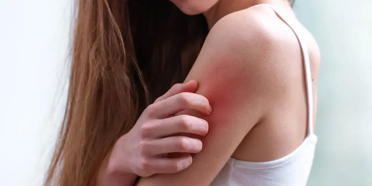 Una persona se rasca el brazo, con la piel enrojecida por los granos por sudor.
