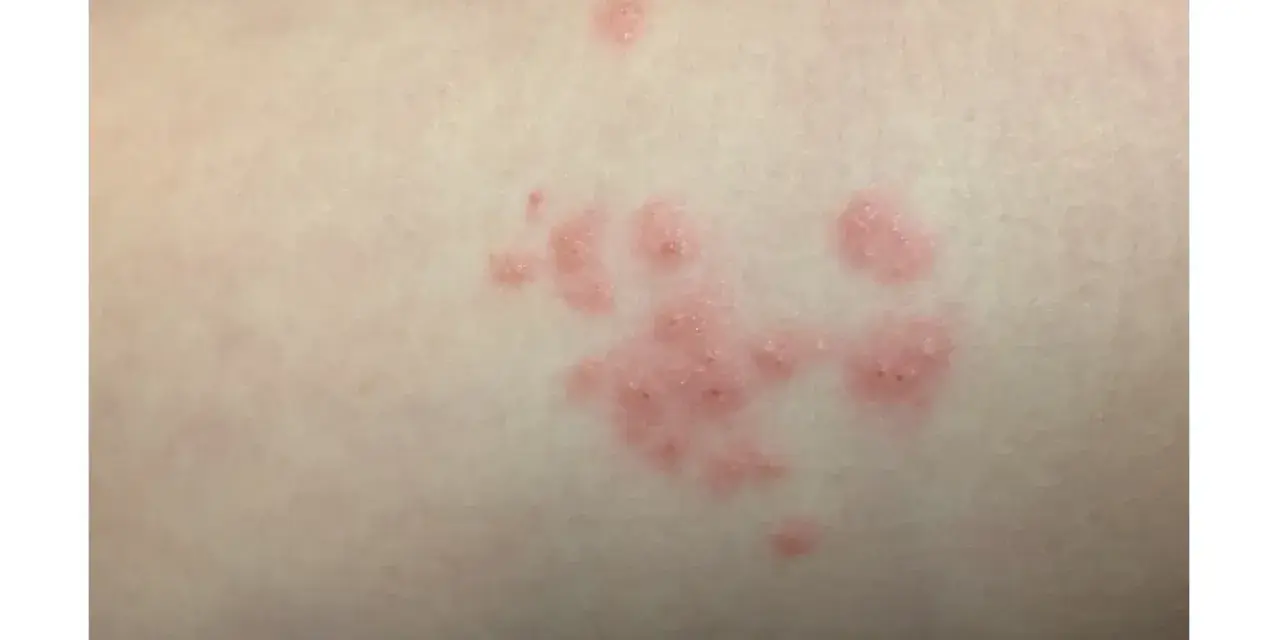 Manchas rosadas en la piel sin picor, agrupadas en racimos.