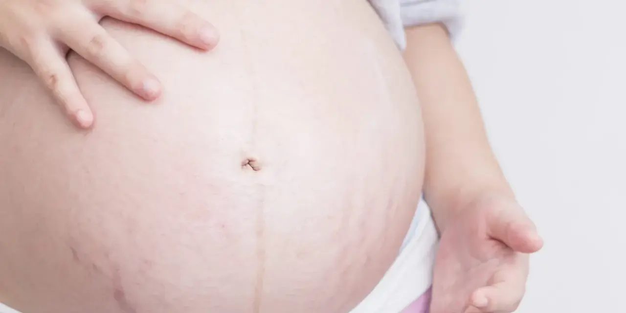 Barriga de embarazada con estrías moradas, un signo de la vida que crece.