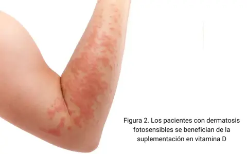 Brazo con erupción cutánea roja y elevada. La vitamina D es clave para la salud de la piel, especialmente para quienes sufren de dermatosis fotosensibles.
