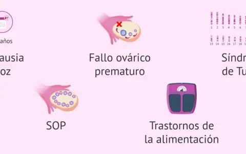 Ilustración sobre menopausia precoz, fallo ovárico, SOP, síndrome de Turner y trastornos alimentarios, causas de falta de estrógenos remedios naturales.
