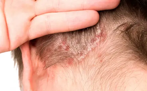 Una mano cubre parte de la cabeza, revelando parches rojos y escamosos en el cuero cabelludo, indicativos de dermatitis seborreica.