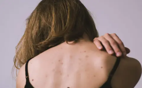 Vista posterior de una persona con granos en la espalda, algunos lunares y cabello castaño.