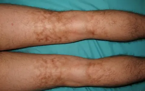 Piernas con manchas marrones irregulares y vello oscuro.