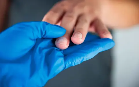 Manos con callos, examinadas con guante azul.