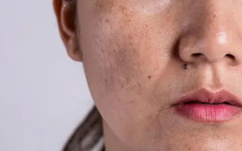 Primer plano de una cara con melasma y un pequeño lunar que parece un bigote.