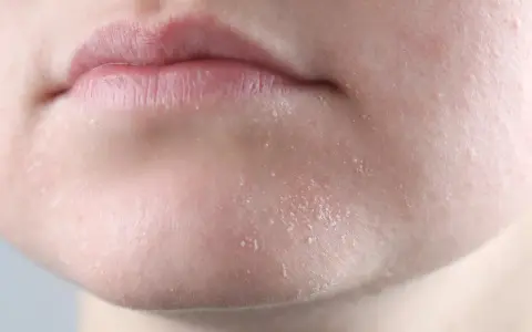 Primer plano de labios agrietados y piel seca cara con escamas visibles.