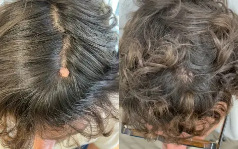 Comparación de lunares en la cabeza antes y después de un tratamiento. El lunar inicial es prominente y rosado, mientras que en la segunda imagen se observa una mejora significativa.