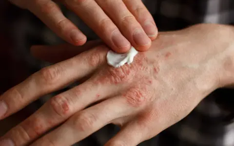 Persona aplica crema en sus manos afectadas por psoriasis, buscando alivio para la piel irritada.