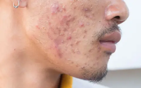 Primer plano de un rostro con acné severo. Se observa una oreja con un pendiente. El ácido hialurónico es bueno para el acné, ayudando a hidratar y calmar la piel.