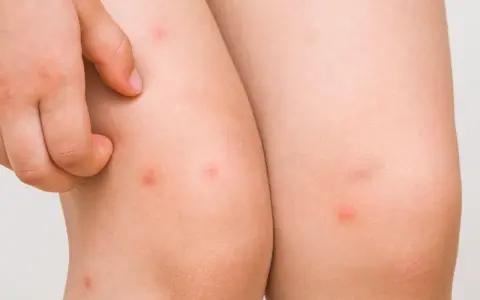 Un niño se rasca un sarpullido en las piernas. Se ven varias picaduras rojas y elevadas en la piel.
