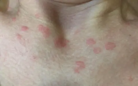 Primer plano de la piel del cuello y el pecho con varias ronchas rojas, algunas agrupadas y otras dispersas.