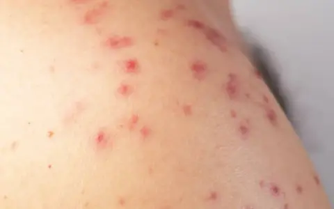 Primer plano de sarpullidos en la piel, con pequeñas protuberancias rojas y algunas marcas de acné.