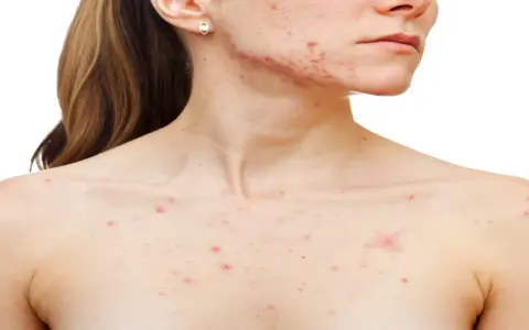 Persona con granos en el pecho y rostro, mostrando la afectación de la piel por acné.