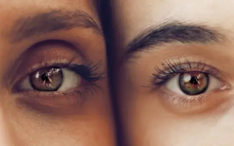 Primer plano de dos ojos, uno con ojeras vasculares pronunciadas, el otro con piel clara y sin ellas.