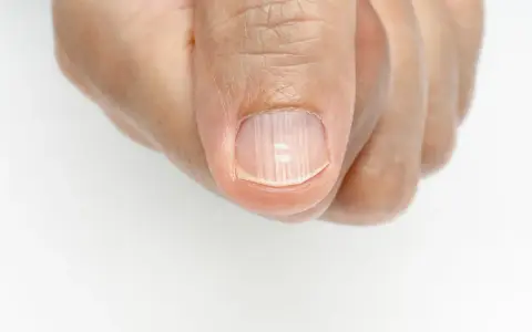 Uña con estrias verticales, mostrando la textura y posibles irregularidades.