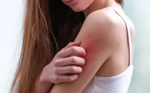 Una persona se rasca el brazo, con la piel enrojecida por los granos por sudor.