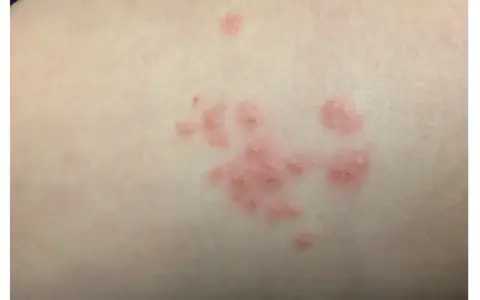 Manchas rosadas en la piel sin picor, agrupadas en racimos.