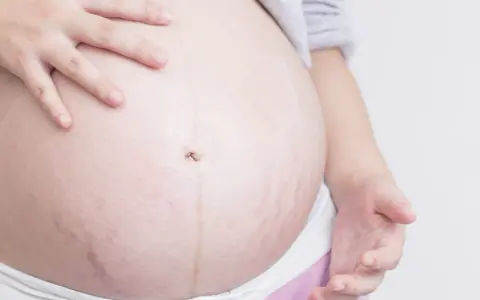 Barriga de embarazada con estrías moradas, un signo de la vida que crece.