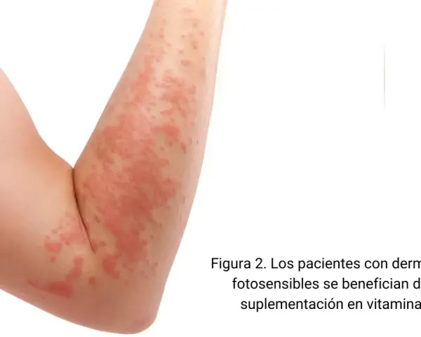 Brazo con erupción cutánea roja y elevada. La vitamina D es clave para la salud de la piel, especialmente para quienes sufren de dermatosis fotosensibles.