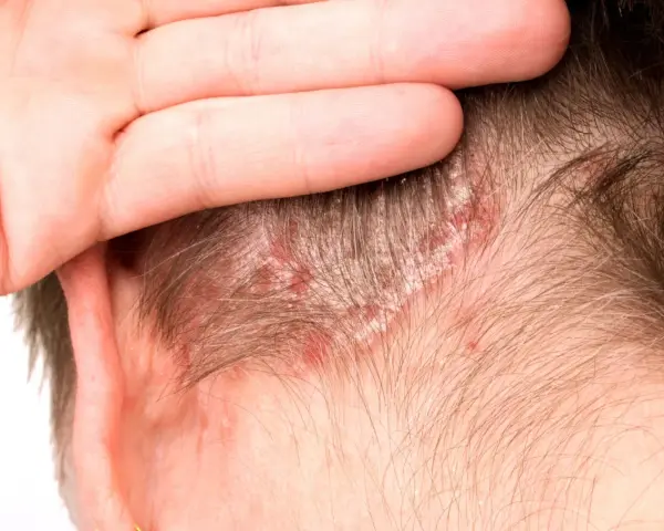 Una mano cubre parte de la cabeza, revelando parches rojos y escamosos en el cuero cabelludo, indicativos de dermatitis seborreica.